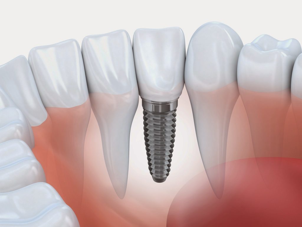 Pesquisas atingem resultados inesperados na aparente diferença que diferentes remédios causam no uso de implantes (Fonte: Divulgação)