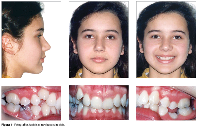 Dental Press – Má oclusão Classe II, divisão 2 de Angle com ...