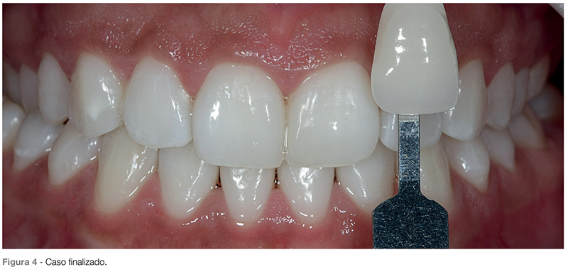 clareamento dental caseiro 22 tempo clareamento dental caseiro 22 tempo