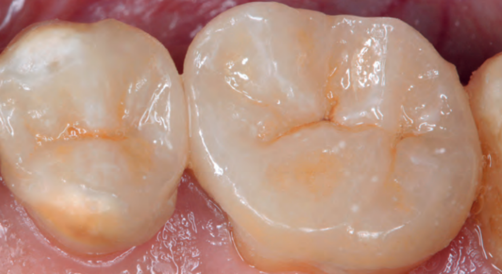 Dental Press Endocrown passo a passo, do laboratório à clínica