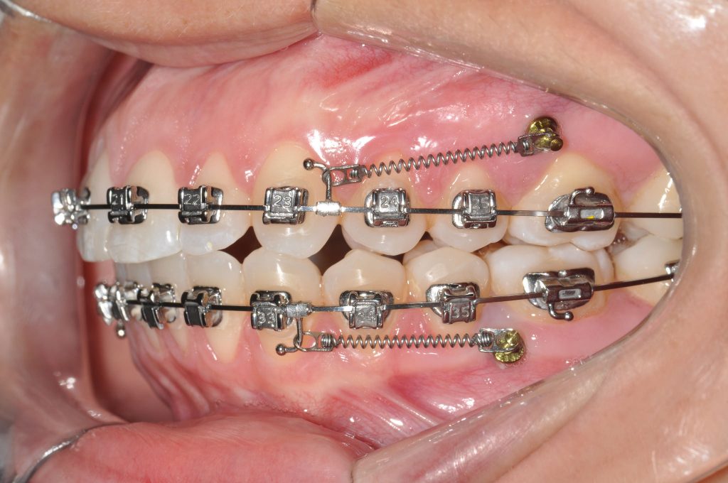 Dental Press Sistema de Aparelhos Autoligados e Miniparafusos