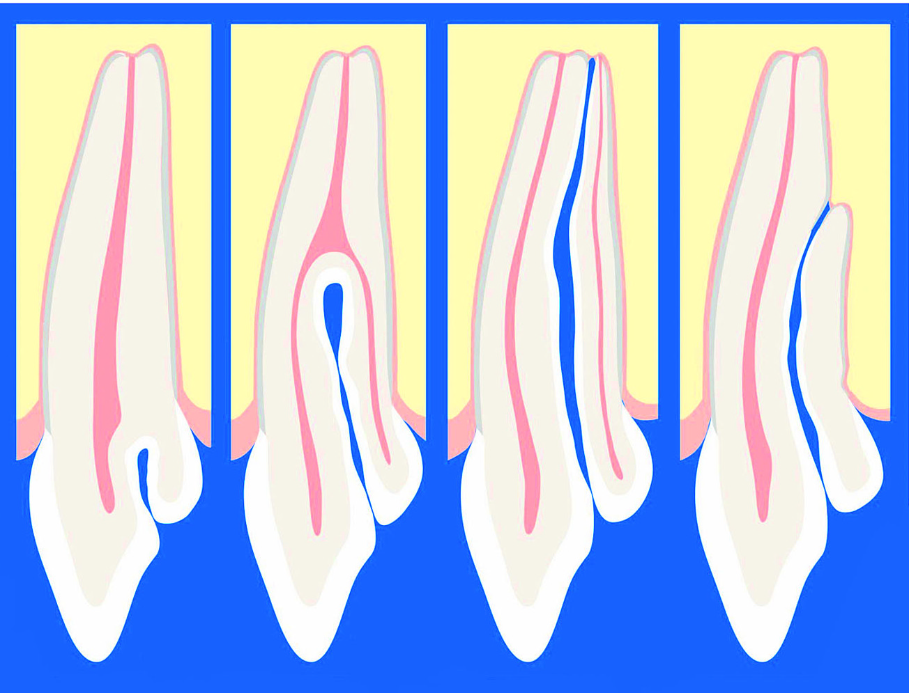 dens invaginatus Dental Press O Portal de conteúdo de Odontologia