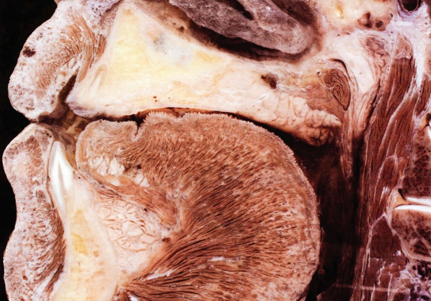 Peça anatômica destacando a delica- deza da tábua óssea vestibular na região dos in- cisivos inferiores (Foto: reprodução do artigo)