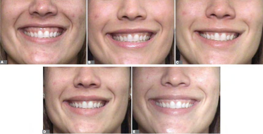 sorriso gengival Sorriso gengival