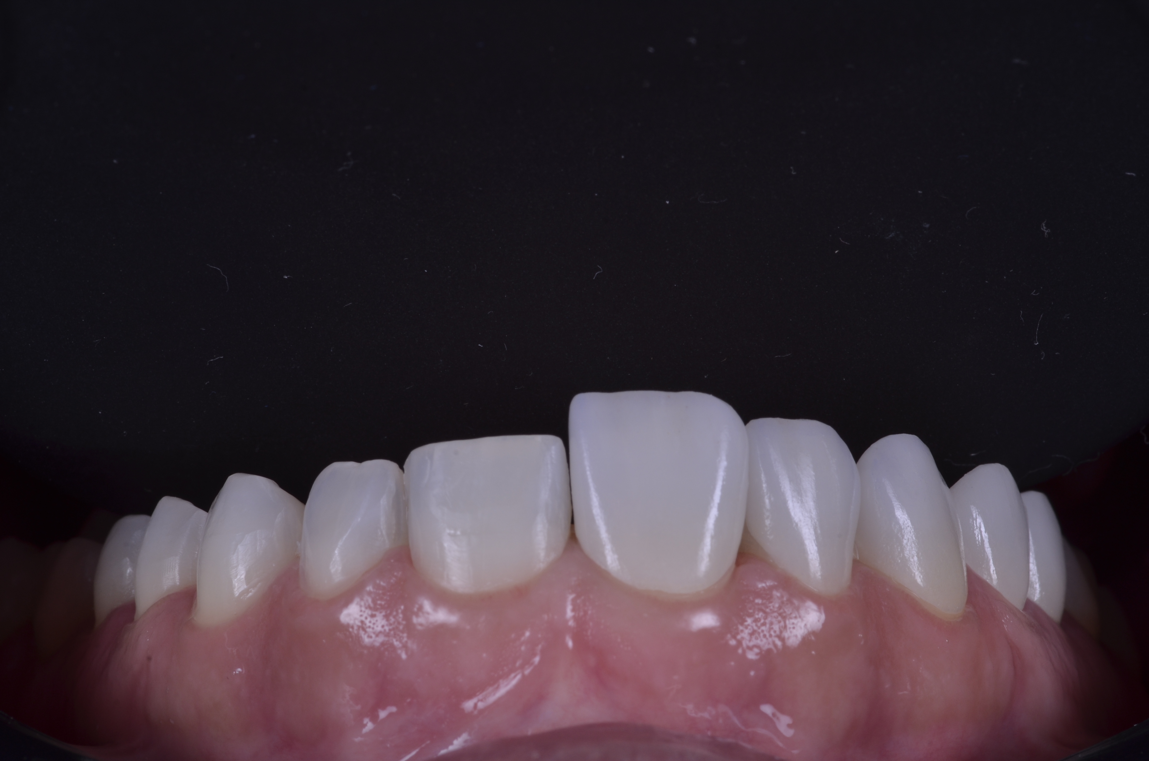 Dental Press 4 fatos sobre os dentes que receberão laminados cerâmicos