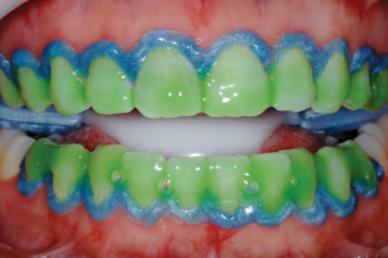 clareamento dental