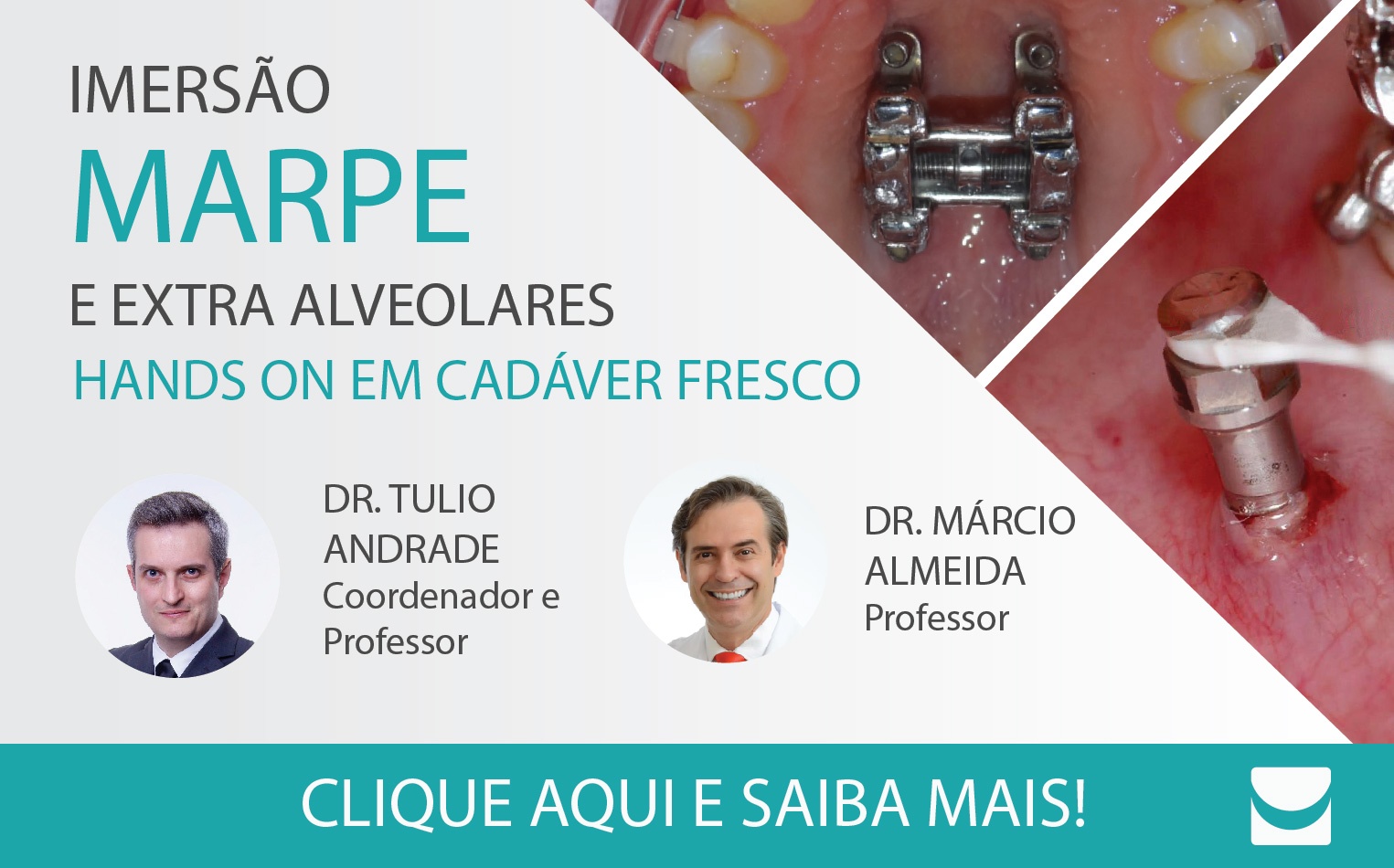 Imersão em MARPE e extra alveolares