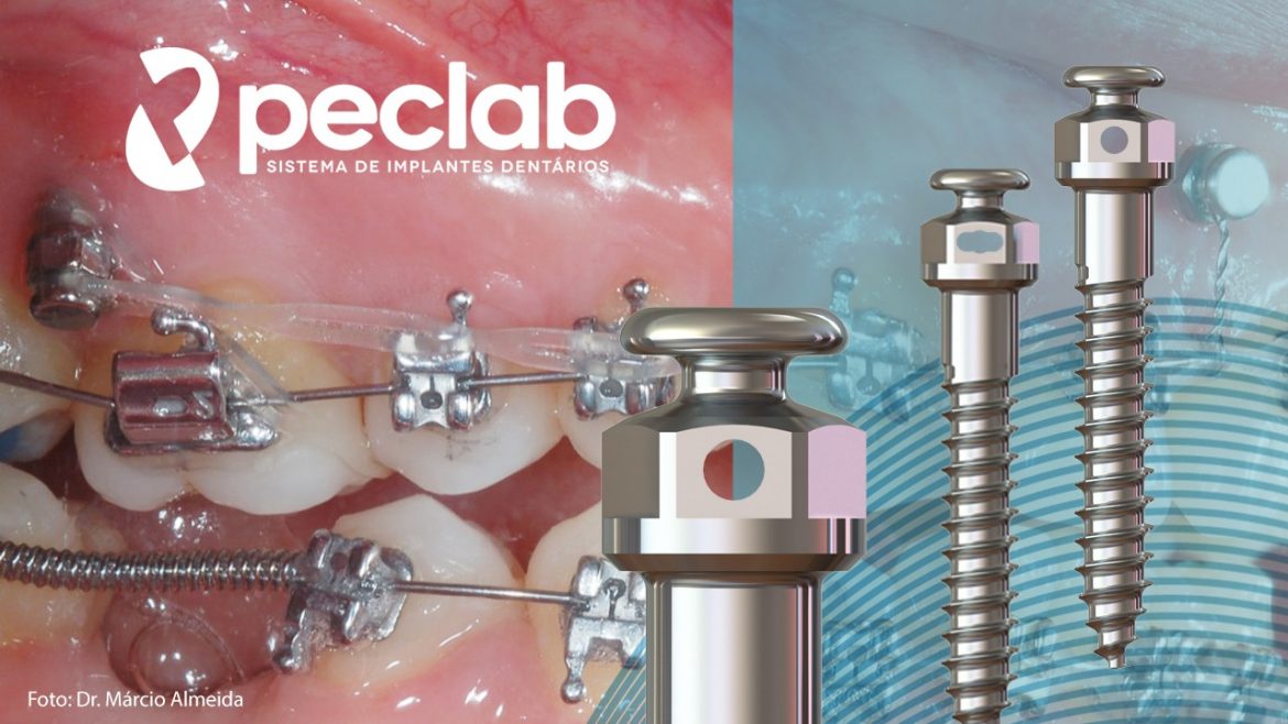 Dental Press Conheça os miniimplantes da EA da PecLab