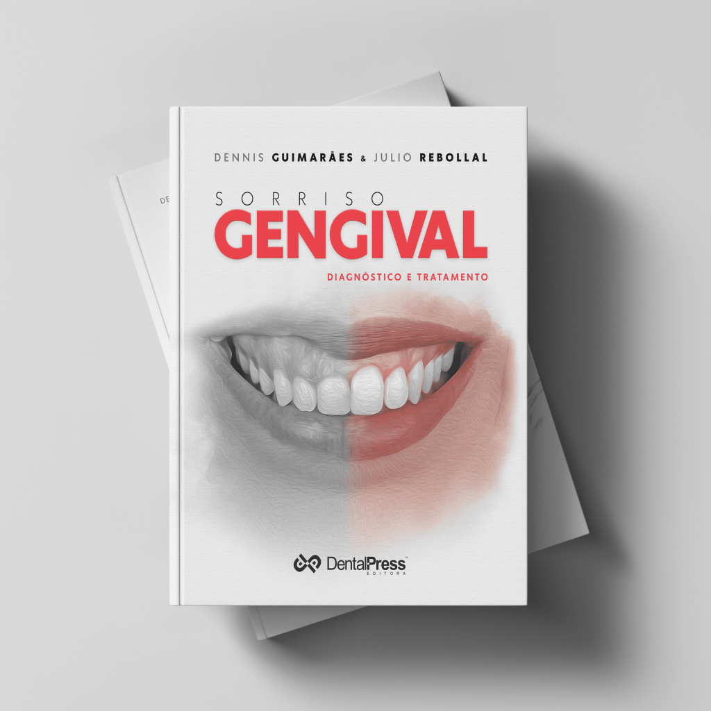 Sorriso Gengival - Diagnóstico e Tratamento