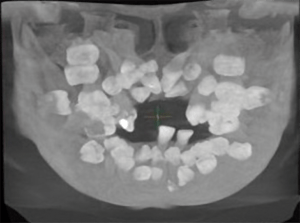 Radiografia do paciente com a condição rara da doença de Pierre-Marie e Santon. Dental Press. Clinical Orthodontics. Revista Clínica de Ortodontia Dental Press.