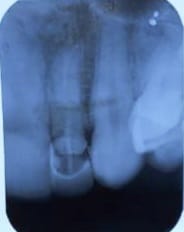 Fratura dental; Gabigol; Flamengo; Fratura no dente; Raio X