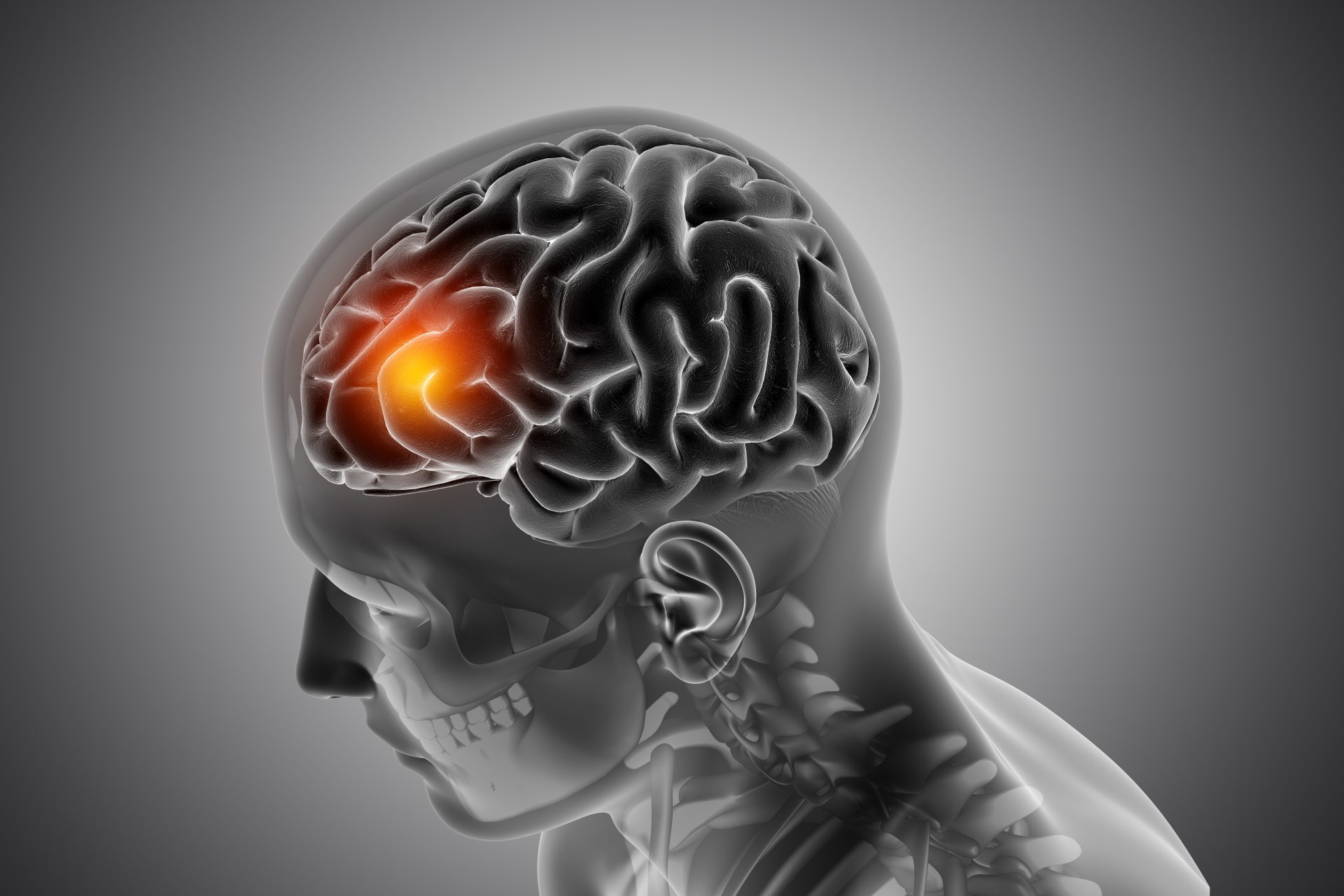 Abscessos cerebrais podem estar ligados à bactérias orais