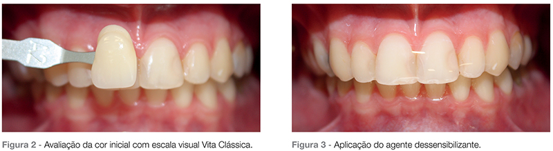 Clareamento dentário