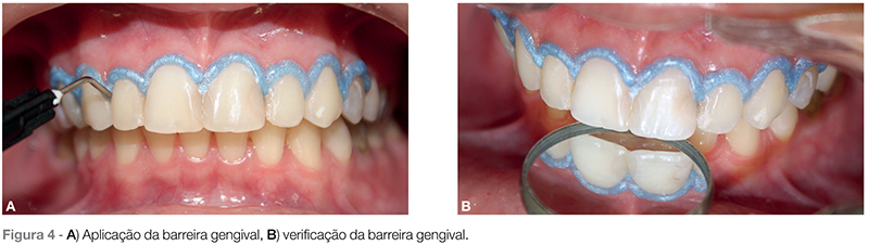 Clareamento dentário