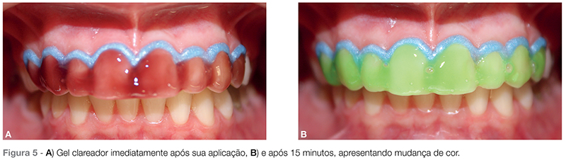 Clareamento dentário