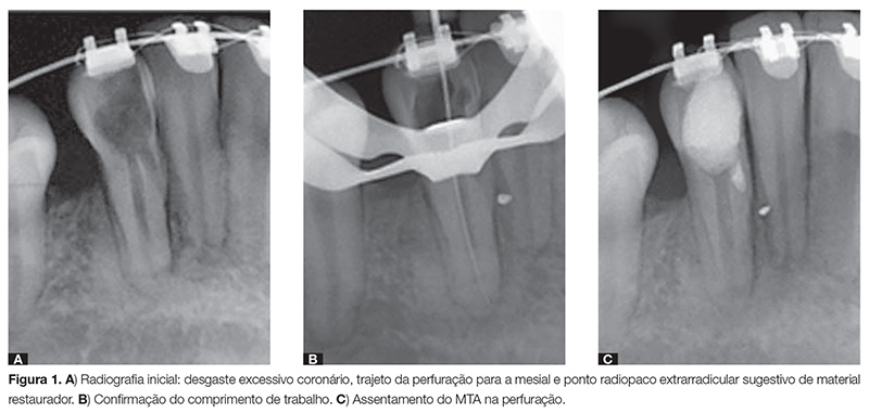 perfuração radicular
