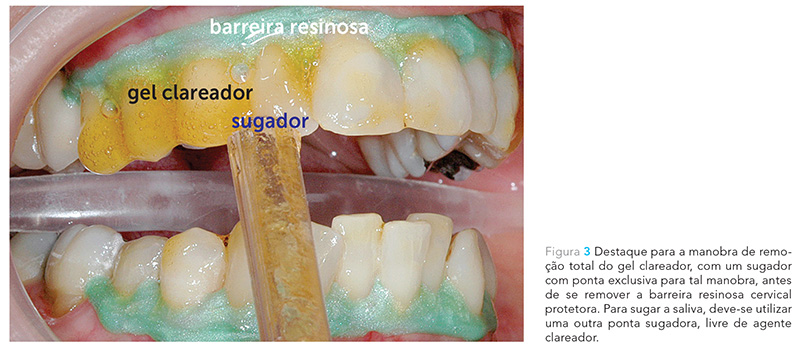 clareamento dental