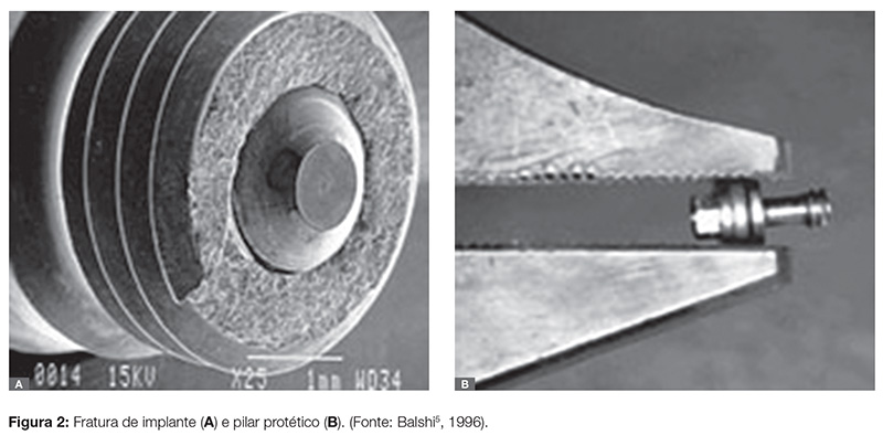 implant_v07_n04_90fig02