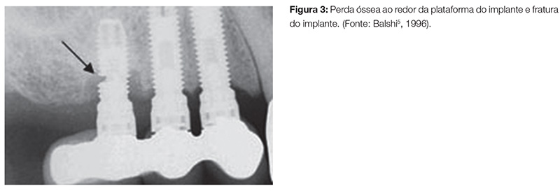 implant_v07_n04_90fig03