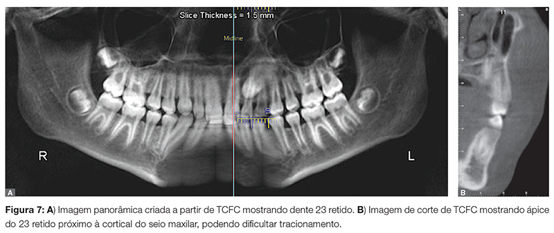 vantagens da tomografia