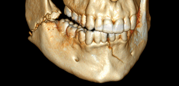 mandible fracture research_1466598962