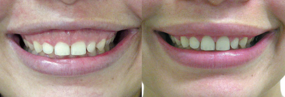 botox_interna