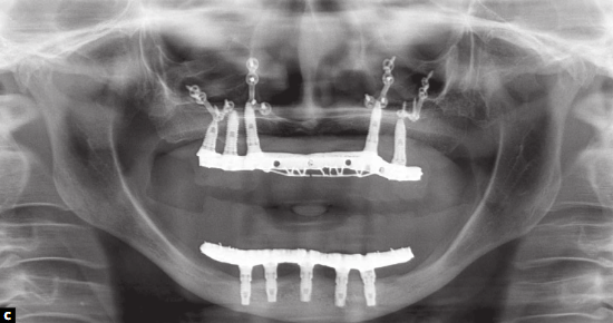 reabilitação implantossuportada