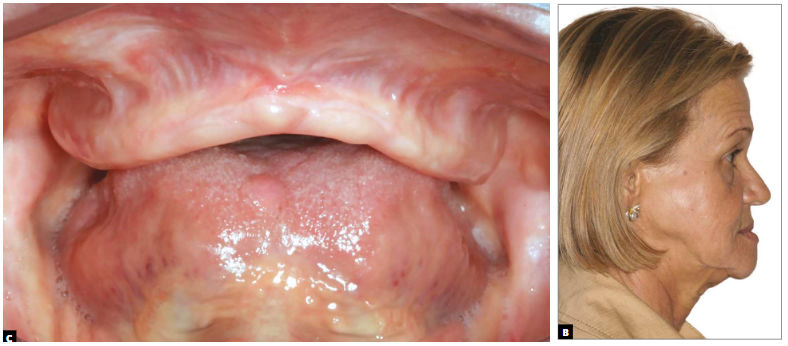 reabilitação implantossuportada