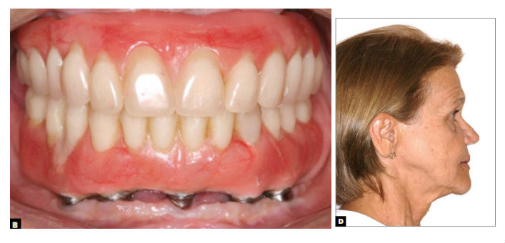reabilitação implantossuportada